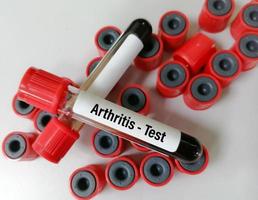 Blood sample tube for analysis of  Arthritis RA profile test in laboratory. Rheumatoid Arthritis. photo