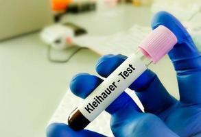 Kleihauer Betke test or Kleihauer test, is utilized to determine if there is fetal blood in maternal circulation, Foeto-maternal haemorrhage or FMH photo