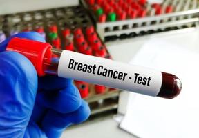 Scientist holding blood sample for Breast cancer test, CA-15.3. photo