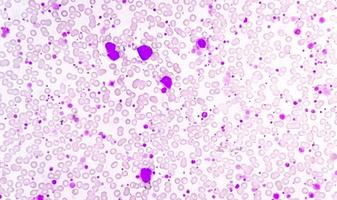 crónico mieloide leucemia o cml en acelerado fase con trombocitosis. crónico mielógeno leucemia. foto