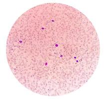 sangre película debajo microscópico demostración microcítico hipocrómico anemia foto