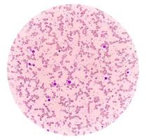 Blood Film under microscopic showing Microcytic Hypochromic Anemia photo