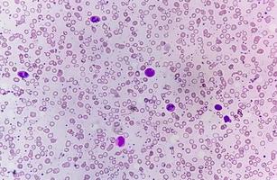 Blood Film under microscopic showing Microcytic Hypochromic Anemia photo