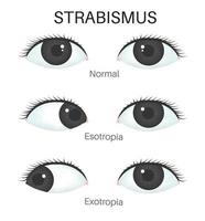 tipos de estrabismo- esotropía y exotropía vector