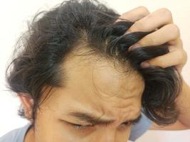 Shocked face of Asian man getting bald and lost hair in isolated white background photo