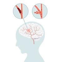 Ischemic stroke and hemorrhagic stroke, stroke brain concept in flat vector. vector