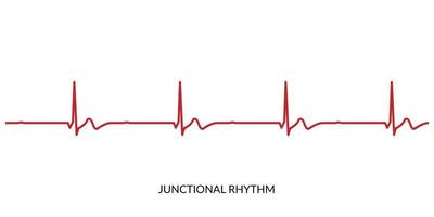 ECG Heartbeat Line. Electrocardiogram vector illustration. Junctional Rhythm