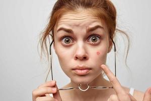 woman face with pimple skin problems close-up photo
