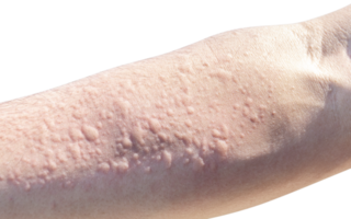 Allergic reaction to dust on arm png