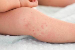 A small child with a red rash on the leg sits on the bed. Children is allergies. photo