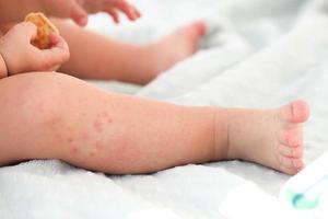 A small child with a red rash on the leg sits on the bed. Children is allergies. photo