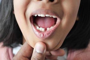 detail shot of child with teeth missing photo