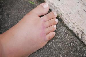 close up of women feet with swelling photo