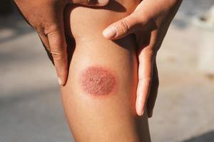 Burning Injuries on leg woman photo