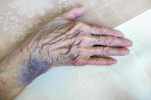 el mano de un mayor mujer con moretones foto