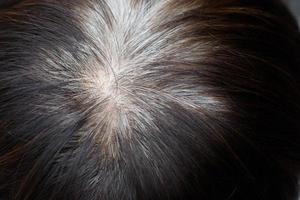 Back view of young people premature gray hair, showing black hoary hair roots on head change to senior old man outdoor. photo