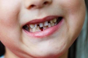 pequeño niña cayó un bebé diente. niño boca con agujero Entre el dientes. superficial departamento de campo foto