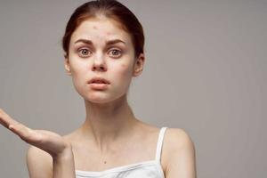 red-haired woman in a white t-shirt pimples on the face light background photo