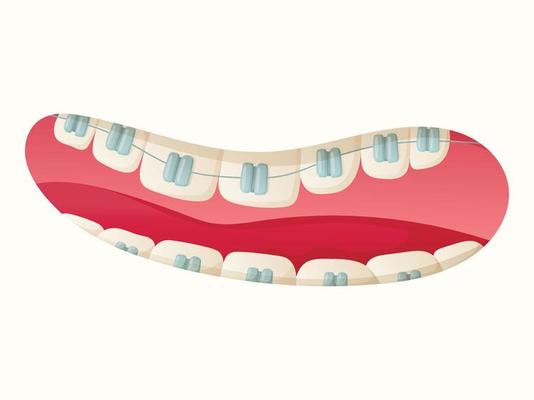 Isolated cartoon illustration of open mouth with teeth and dental braces.
