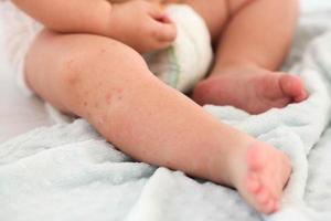 un pequeño niño con un rojo erupción en el pierna se sienta en el cama. niños es alergias foto