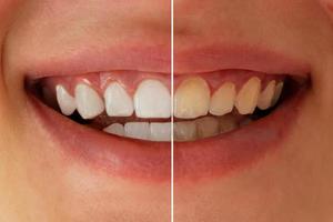 Teeth whitening before after. Woman teeth before and after whitening. Dental health concept. Oral care concept photo