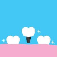 tooth implantation icon vector illustration