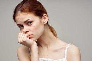 red-haired woman with pimples on the face hygiene isolated background photo