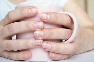 White spots on fingernails, Leukonychia photo