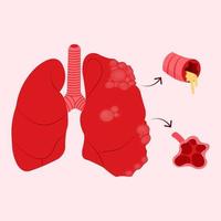 ilustración de un enfermo pulmón afectado por copd o crónico obstructivo pulmonar enfermedad, Perfecto para médico presentaciones o educativo materiales vector