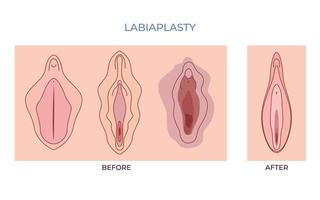 Labiaplasty. vaginoplasty. women genital of minor Vulval labia loose lips beauty surgery to tighten vector