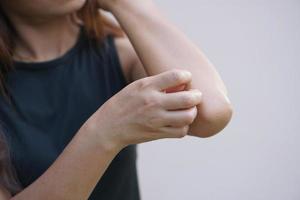 Asian woman having itchy skin on arm photo