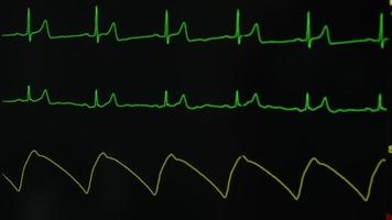 Close-up view of heart rate and respiratory rate monitoring in intensive care unit video