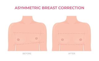 Asymmetric breast correction before and after plastic surgery front view vector