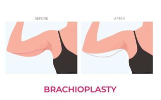 braquioplastia o Superior brazo levantar el plastico cirugía en mujer. frente ver vector