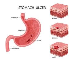 Stomach erosion and ulcer illustration vector