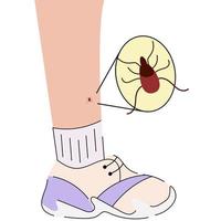 The human leg with  the tick bite. Tick bite leg.Tick bite.  Healthcare illustration. vector