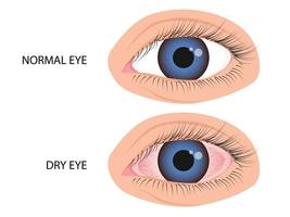 Human eye healthy and dry. Symptoms of keratitis, allergy, conjunctivitis, uveitis vector