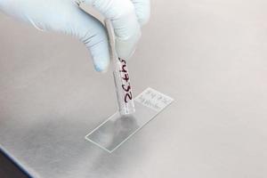 Scientist preparing a peritoneal fluid sample for cytology analysis in the laboratory. Cancer diagnosis concept. Medical concept. photo