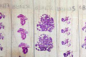 Stained tissue biopsy on glass slides in pathology laboratory photo