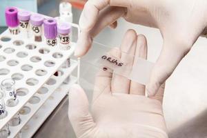 Scientist preparing a bone marrow smear in the laboratory. Blood smear. photo