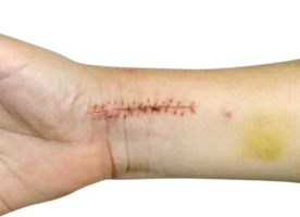 detailopname hechtingen van gebroken arm chirurgie en gekneusd geïsoleerd png