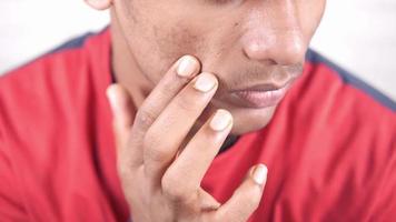 close up of young asian man face with skin problem isolated on white video