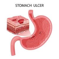 Peptic ulcer in stomach with layers visualization vector