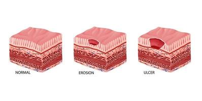 péptico úlcera etapas desarrollo ilustración vector