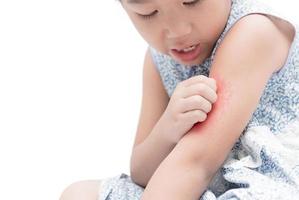 asiático niña rasguño el picar con mano su brazo porque de mosquito foto