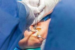 grupo de ortopédico cirujanos ejecutando cirugía en un paciente brazo foto