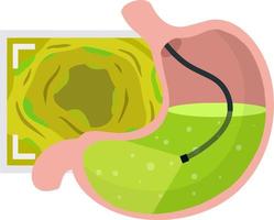 gastroscopia. endoscopia y digestivo problemas. manguera con cámara. procedimiento con interno órganos dibujos animados plano ilustración. médico visual inspección de estómago vector