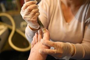 Podiatrist takes care of ingrown toenail with nail braces photo