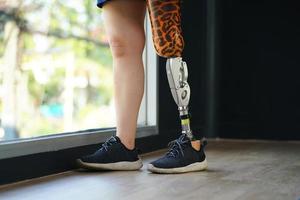 Young female with one prosthetic leg with the practice of using prosthetic legs to walk, exercise and and daily activities photo
