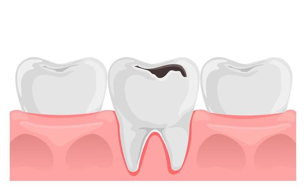 Teeth with caries in gum. Dental anatomy. Flat vector illustration isolated on white.